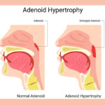 Adenoidid