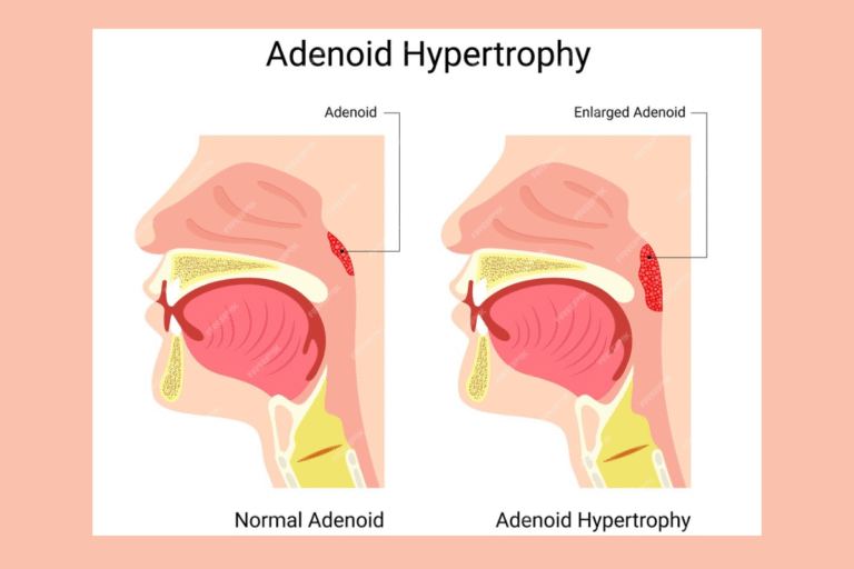 Adenoidid