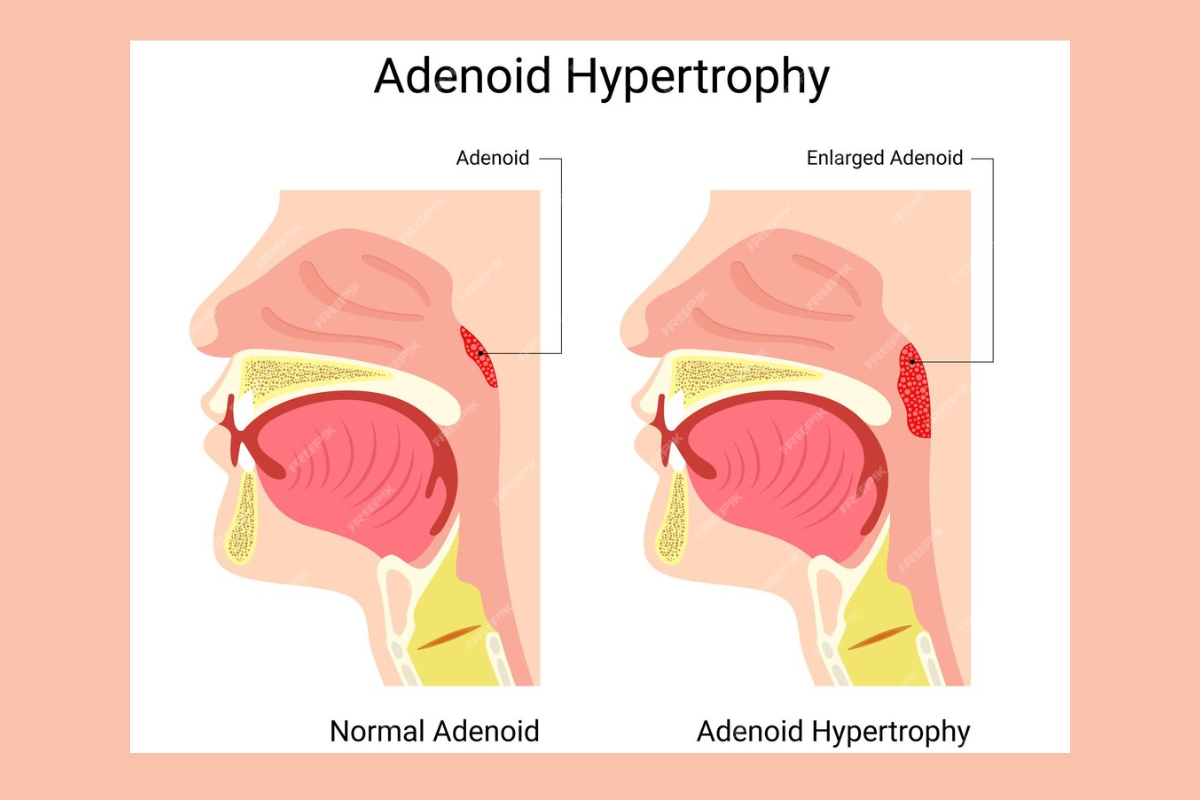 Adenoidid
