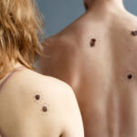 mole vs birthmark