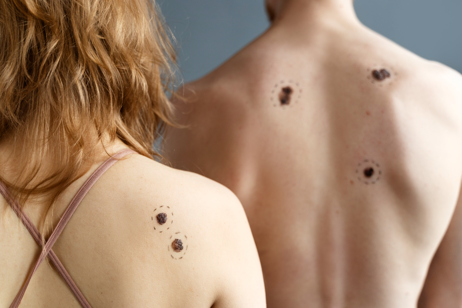 mole vs birthmark