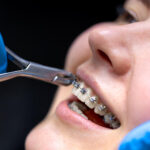 how much do braces cost