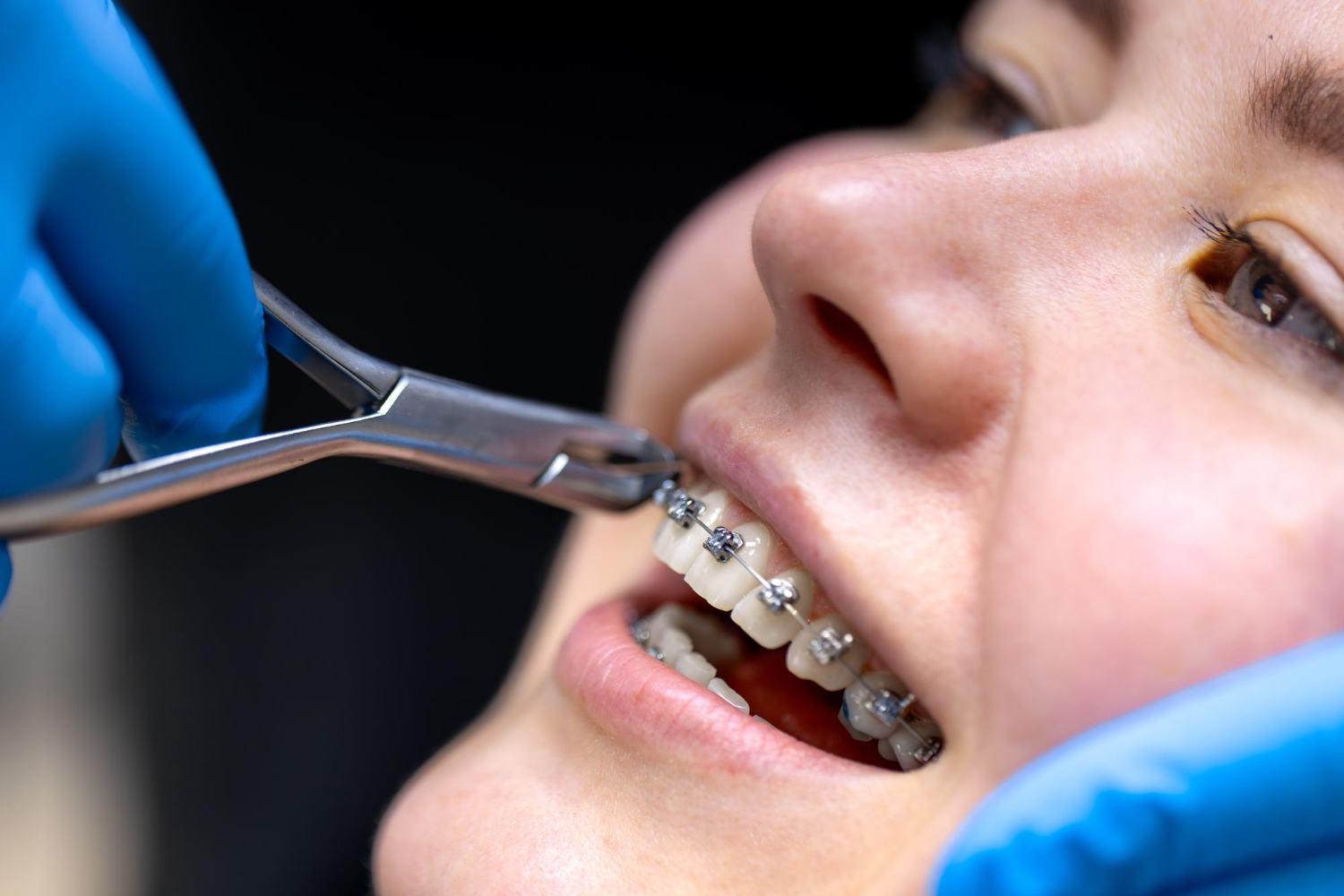how much do braces cost