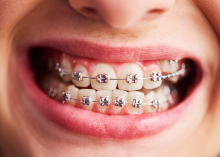 metal teeth